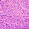 1A14 Intravascular Papillary Endothelial Hyperplasia (Case 1) H&E 4