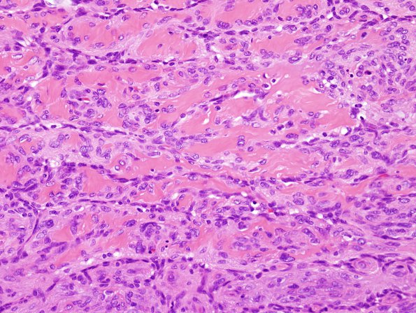 1A14 Intravascular Papillary Endothelial Hyperplasia (Case 1) H&E 4