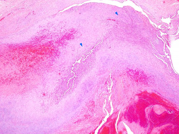 1A2 Intravascular Papillary Endothelial Hyperplasia (Case 1) H&E 5 copy