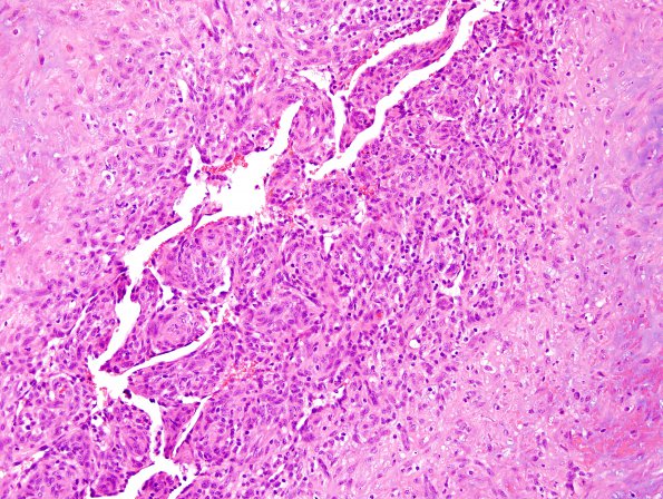 1A3 Intravascular Papillary Endothelial Hyperplasia (Case 1) H&E 6