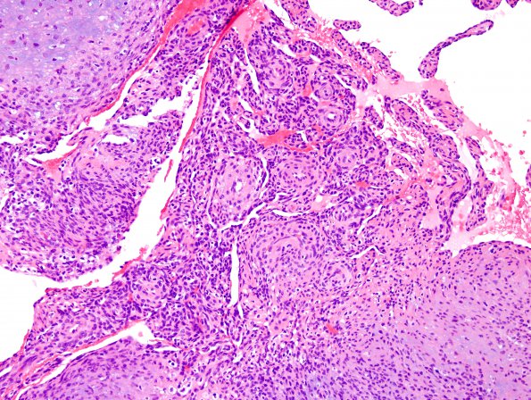 1A4 Intravascular Papillary Endothelial Hyperplasia (Case 1) H&E 16