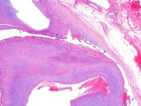 1A5 Intravascular Papillary Endothelial Hyperplasia (Case 1) H&E 15 copy