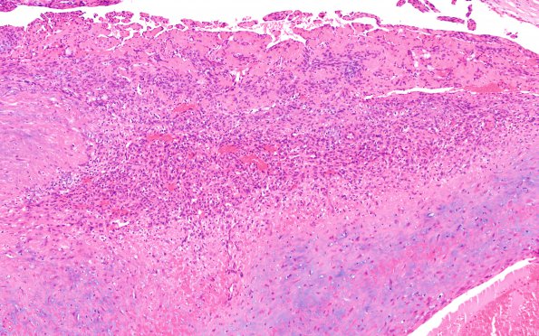 1A6 Intravascular Papillary Endothelial Hyperplasia (Case 1) H&E 12A