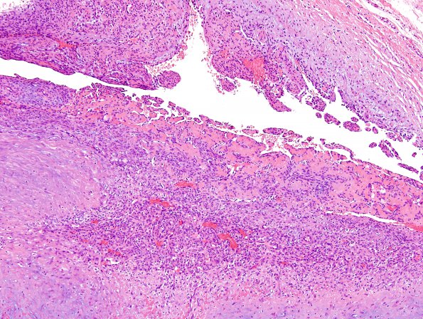 1A7 Intravascular Papillary Endothelial Hyperplasia (Case 1) H&E 12