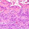 1A8 Intravascular Papillary Endothelial Hyperplasia (Case 1) H&E 14