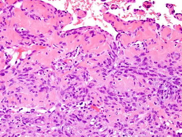 1A8 Intravascular Papillary Endothelial Hyperplasia (Case 1) H&E 14