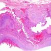 1A9 Intravascular Papillary Endothelial Hyperplasia (Case 1) H&E 17