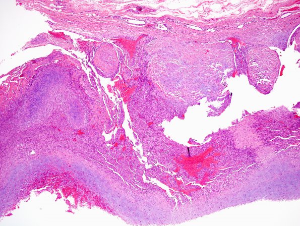 1A9 Intravascular Papillary Endothelial Hyperplasia (Case 1) H&E 17