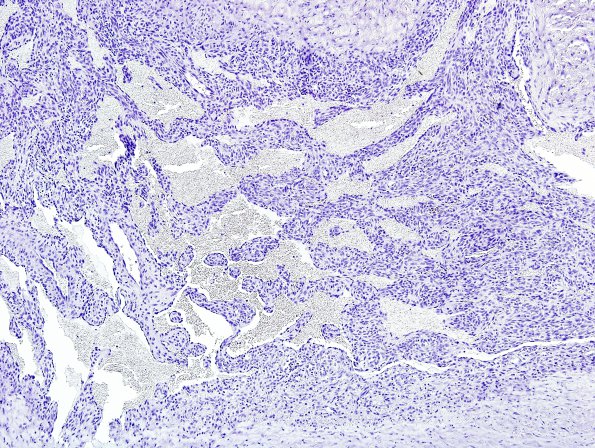 1B1 Intravascular Papillary Endothelial Hyperplasia (Case 1) NEG 6