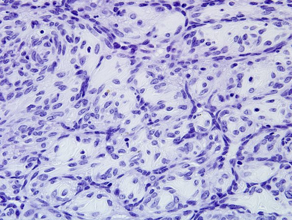 1B2 Intravascular Papillary Endothelial Hyperplasia (Case 1) NEG 2