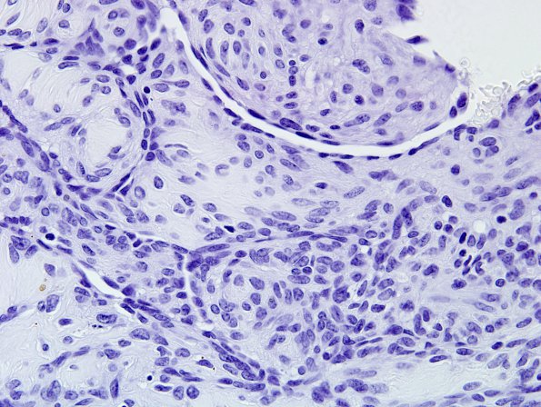 1B3 Intravascular Papillary Endothelial Hyperplasia (Case 1) NEG 3