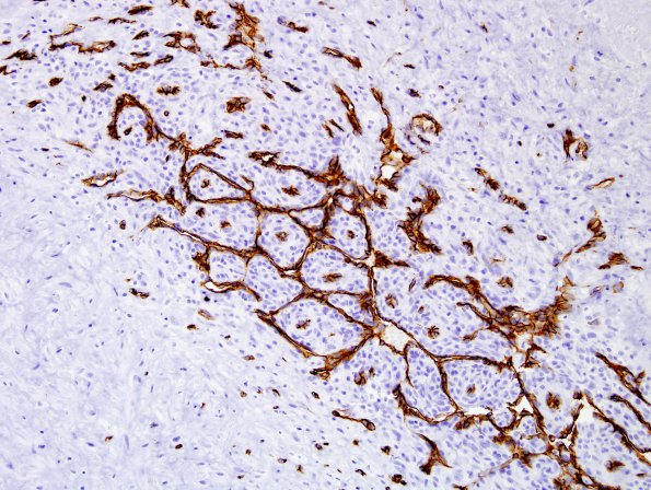 1C10 Intravascular Papillary Endothelial Hyperplasia (Case 1) CD34 4