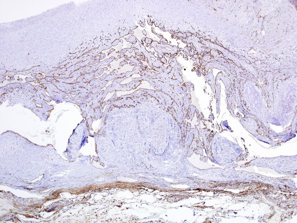 1C2 Intravascular Papillary Endothelial Hyperplasia (Case 1) 1 CD34 11.