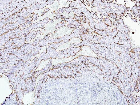 1C3 Intravascular Papillary Endothelial Hyperplasia (Case 1) CD34 5