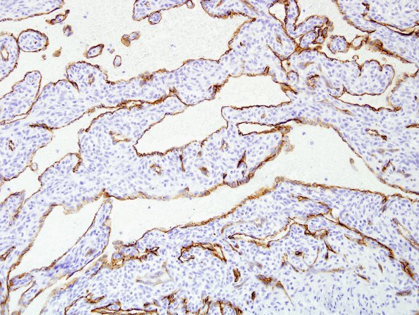 1C4 Intravascular Papillary Endothelial Hyperplasia (Case 1) CD34 6