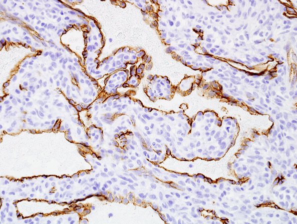 1C5 Intravascular Papillary Endothelial Hyperplasia (Case 1) CD34 7