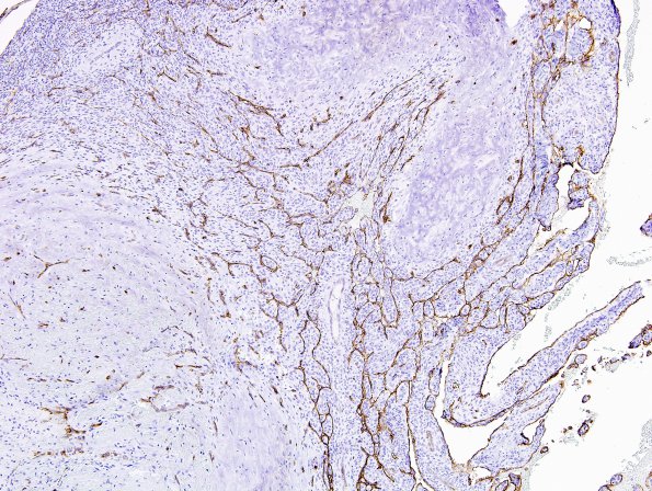 1C6 Intravascular Papillary Endothelial Hyperplasia (Case 1) CD34 8