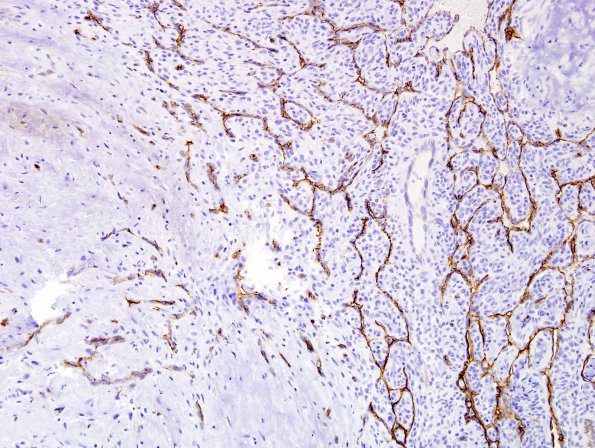 1C7 Intravascular Papillary Endothelial Hyperplasia (Case 1) CD34 9