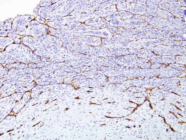 1C8 Intravascular Papillary Endothelial Hyperplasia (Case 1) CD34 1