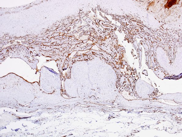 1D2 Intravascular Papillary Endothelial Hyperplasia (Case 1) CD31 7