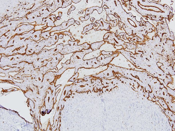 1D3 Intravascular Papillary Endothelial Hyperplasia (Case 1) CD31 6