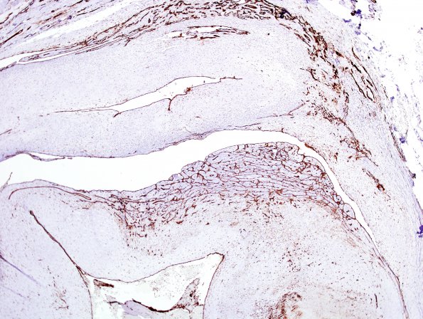 1D5 Intravascular Papillary Endothelial Hyperplasia (Case 1) CD31 3