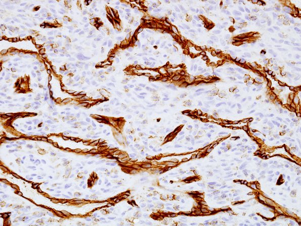 1D7 Intravascular Papillary Endothelial Hyperplasia (Case 1) CD31 4