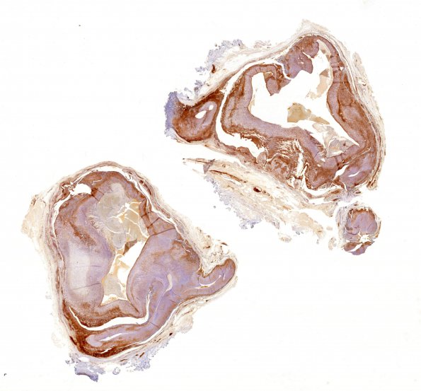 1E1 Intravascular Papillary Endothelial Hyperplasia (Case 1) 1 SMA WM