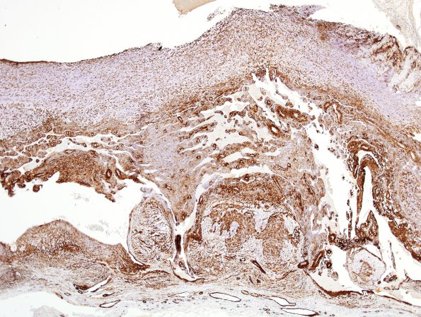 1E2 Intravascular Papillary Endothelial Hyperplasia (Case 1) SMA 9