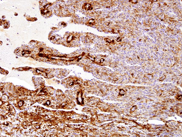 1E3 Intravascular Papillary Endothelial Hyperplasia (Case 1) SMA 3