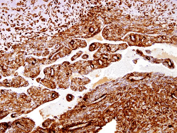 1E4 Intravascular Papillary Endothelial Hyperplasia (Case 1) SMA 8