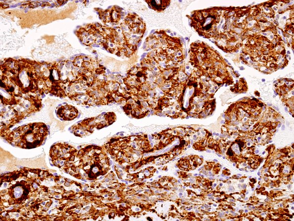 1E5 Intravascular Papillary Endothelial Hyperplasia (Case 1) SMA 5