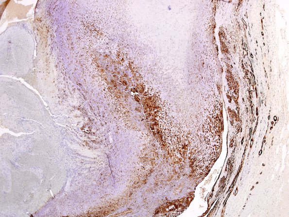 1E6 Intravascular Papillary Endothelial Hyperplasia (Case 1) SMA 11