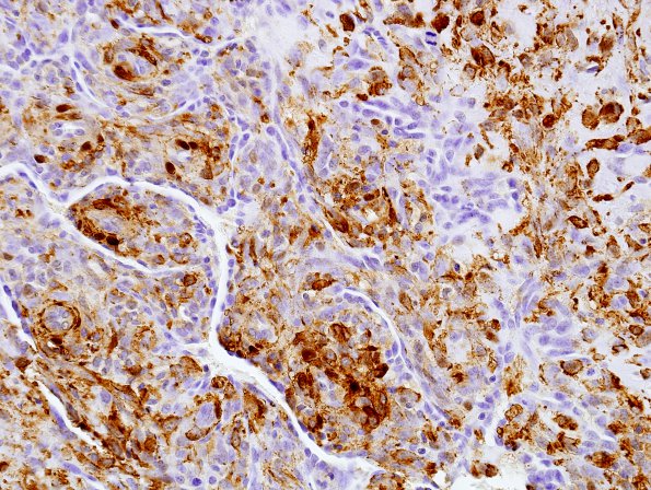 1E7 Intravascular Papillary Endothelial Hyperplasia (Case 1) SMA 13