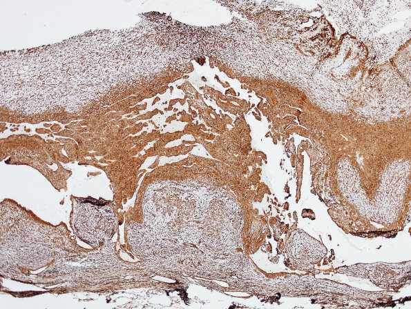 1F2 Intravascular Papillary Endothelial Hyperplasia (Case 1) VIM 2