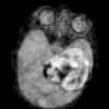 2A1 PEH 7day old (Masson Tumor, Case 2) FLAIR - Copy