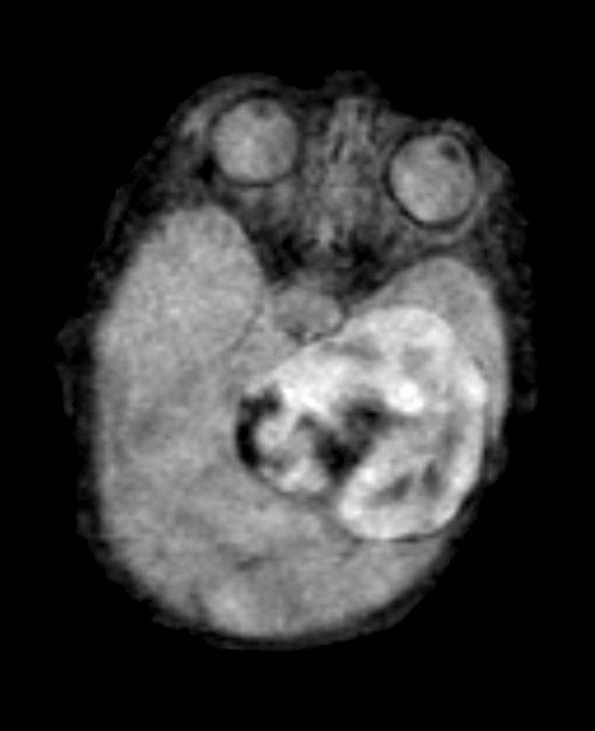 2A1 PEH 7day old (Masson Tumor, Case 2) FLAIR - Copy