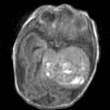 2A2 PEH 7day old (Masson Tumor, Case 2) T1 1 (2) - Copy