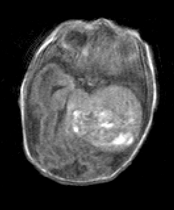 2A2 PEH 7day old (Masson Tumor, Case 2) T1 1 (2) - Copy