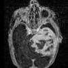 2A3 PEH  7day old (Masson Tumor, Case 2) TOF fl3d 1 - Copy