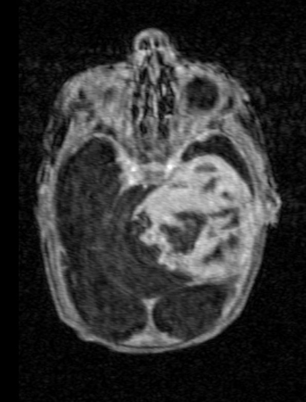 2A3 PEH  7day old (Masson Tumor, Case 2) TOF fl3d 1 - Copy