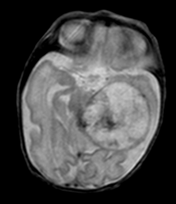 2A4 PEH 7day old (Masson Tumor, Case 2) T2 1 - Copy