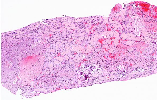 2B1 Intravascular Papillary Endothelial Hyperplasia (Case 2) H&E 1