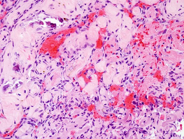 2B2 Intravascular Papillary Endothelial Hyperplasia (Case 2) H&E 2