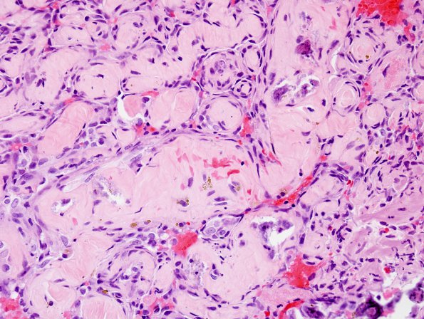 2B3 Intravascular Papillary Endothelial Hyperplasia (Case 2) H&E 3