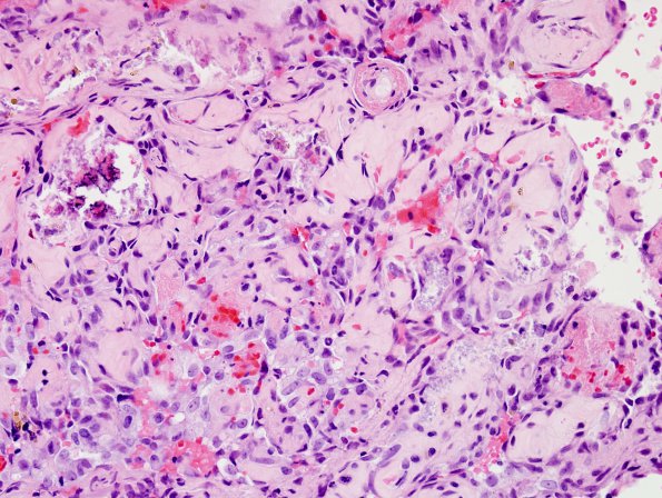 2B4 Intravascular Papillary Endothelial Hyperplasia (Case 2) H&E 6