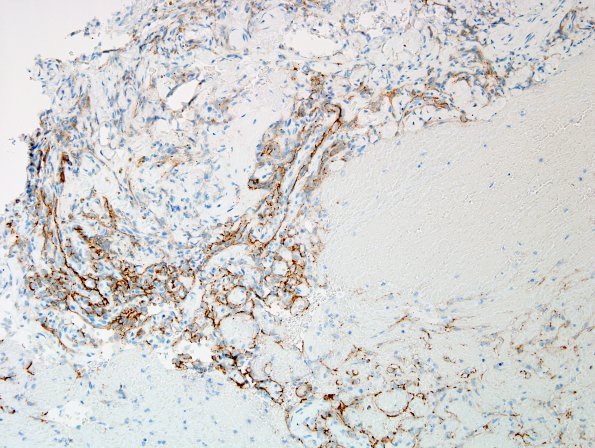 2C1 Intravascular Papillary Endothelial Hyperplasia (Case 2) CD34 6