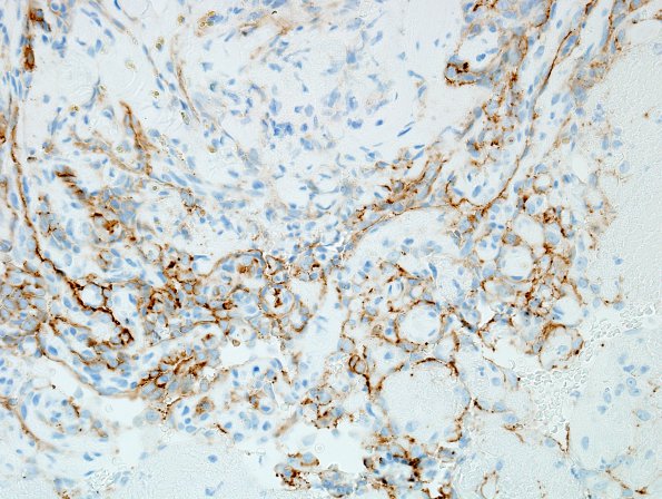 2C2 Intravascular Papillary Endothelial Hyperplasia (Case 2) CD34 3