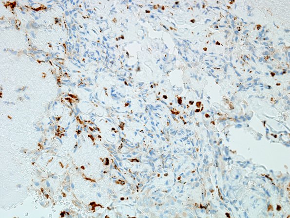 2E1 Intravascular Papillary Endothelial Hyperplasia (Case 2) CD68 3.