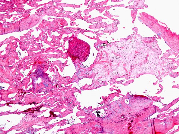 3A2 Intravascular papillary endothelial hyperplasia (Case 3) H&E 2